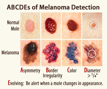ABCDE's of Melanoma