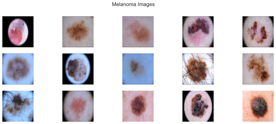 Melanoma Images
