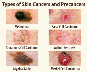 Skin Cancer Types
